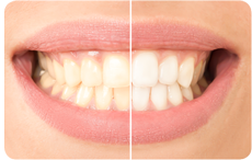 Bleaching Aufhellen Zähne White Emotion Power Bleaching Verfärbungen
