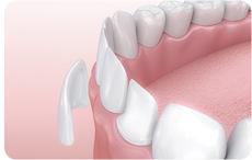 Veneers Keramikschale